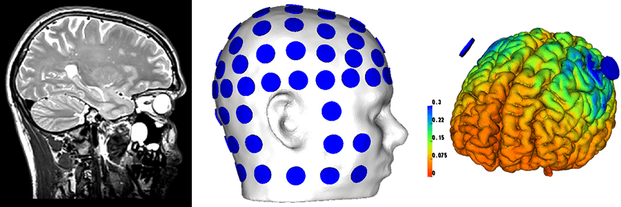 computational head models used to calculate the electric fields induced in the brain by stimulation applied through electrodes on the scalp.